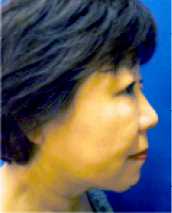 症例NO.