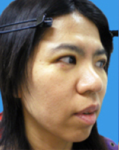 症例NO.