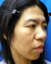 症例NO.
