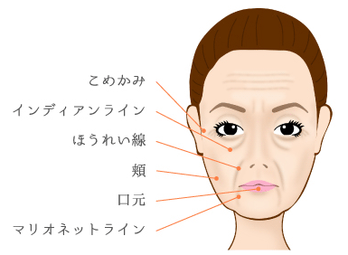 プレミアムオートファイバー注入法の効果的な部位