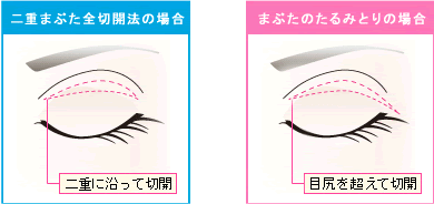 二重まぶた全切開法とまぶたのたるみ取りのデザインの違い