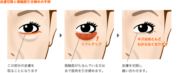 皮膚を切除と眼輪筋引き締めの手術