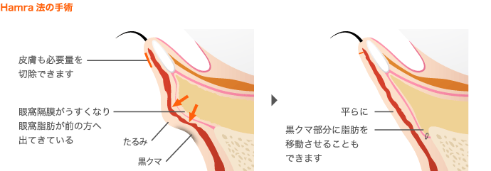 ハムラ法(Hamra法)