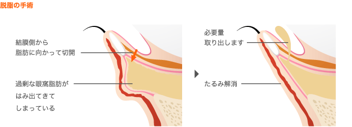 脱脂の手術