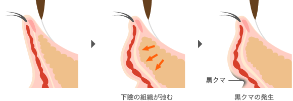 目の下のたるみは、黒クマの直接的な原因に