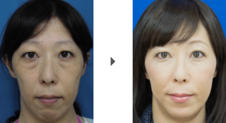 目の下のたるみ取り解消例2