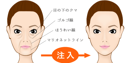 プレミアムオートファイバー法による目の下のたるみ取り