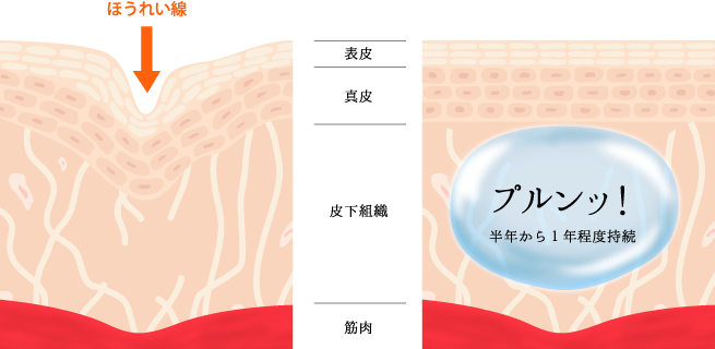 ヒアルロン酸注射を半年から一年程度持続するとこんなにプルンッ!とします。