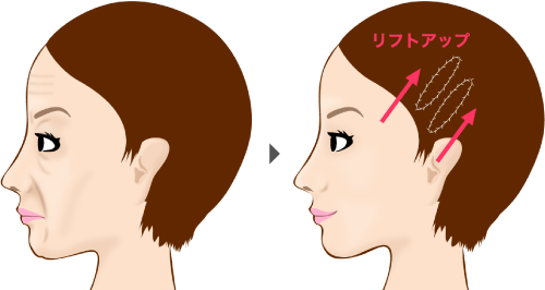 ヴィーナスリフト」は、シワやたるみを引き上げることでほうれい線を目立たなくすることができます