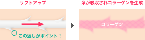 ヴィーナスリフトの仕組み