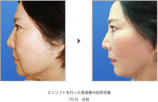 ミニリフトを行った患者様の症例写真