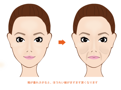 頬が垂れ下がるとほうれい線がますます深くなります