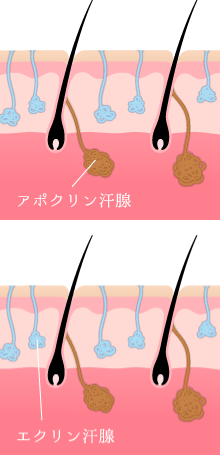 手掌多汗症の治療法