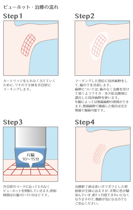ビューホット治療の流れ