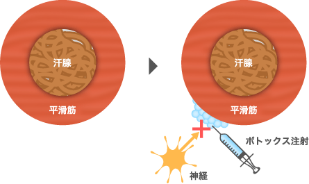手掌多汗症の治療法