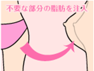 豊胸のメリット