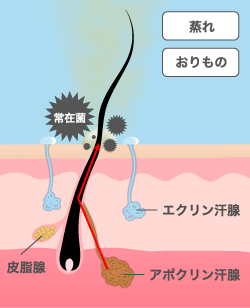 すそわきがの原因