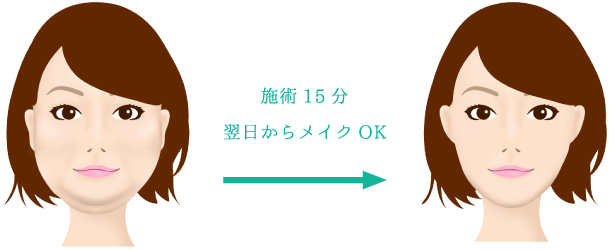 施術15分 翌日からメイクOK
